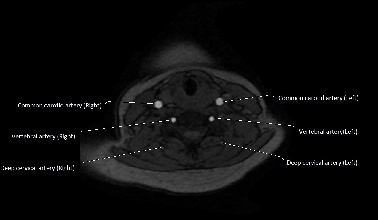 Carotid artery anatomy axial 3T image 43.jpg